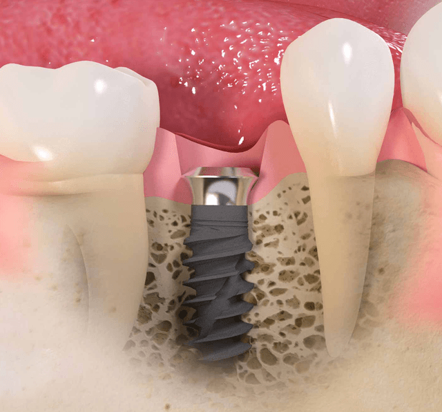 İmplant seçimində nələrə diqqət etməli?