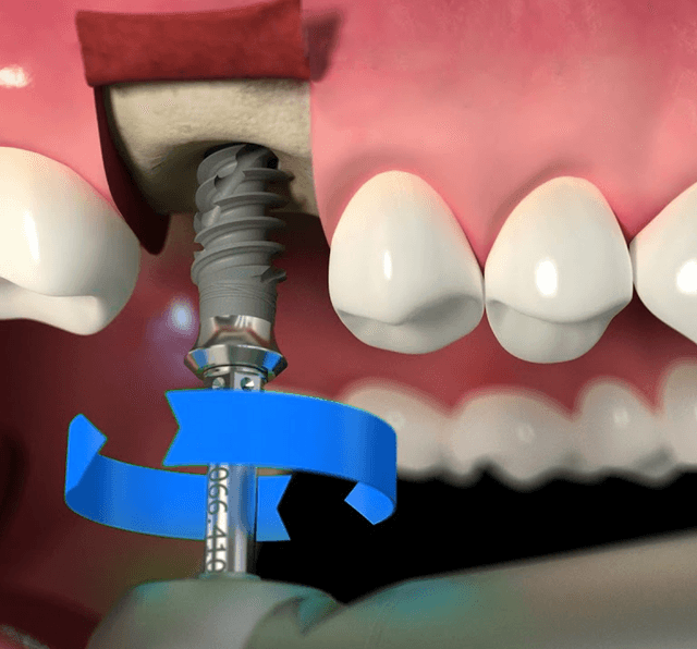 Straumann implantlarının yüksək uğur faizi